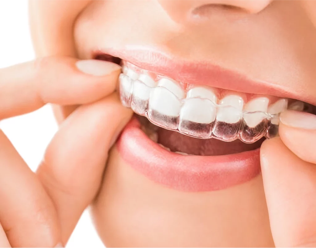 Invisalign_1